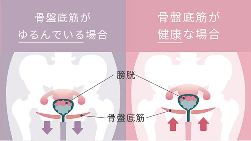 骨盤底筋がゆるんでいる場合と健康な場合の比較