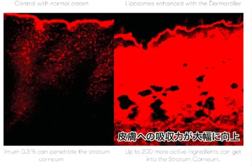 Dermaroller penetration diagram