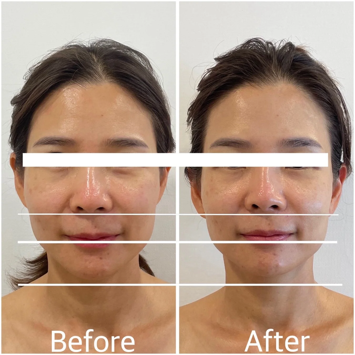 中顔面短縮BeforeAfter