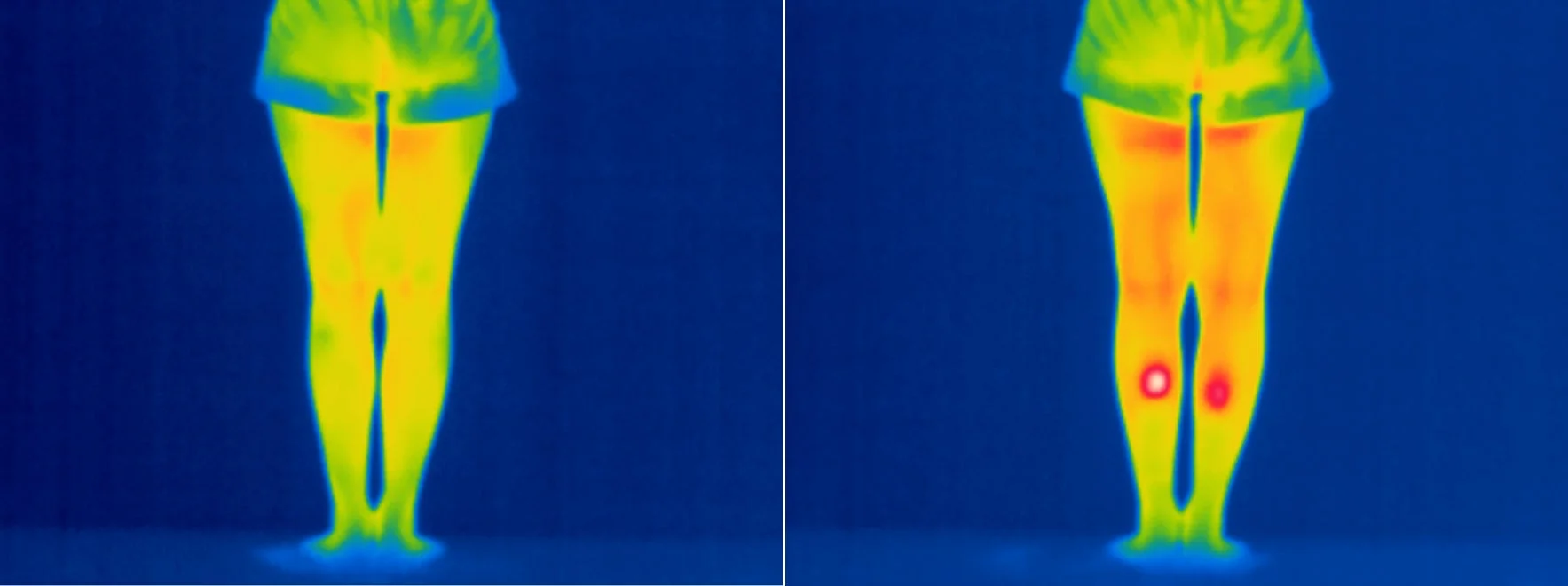 2枚のサーモグラフィー画像で脚の体温分布を比較しています。左は均一な体温を示す一方、右は左右のすねに高温域が確認でき、体温の変化や異常を示唆しています。