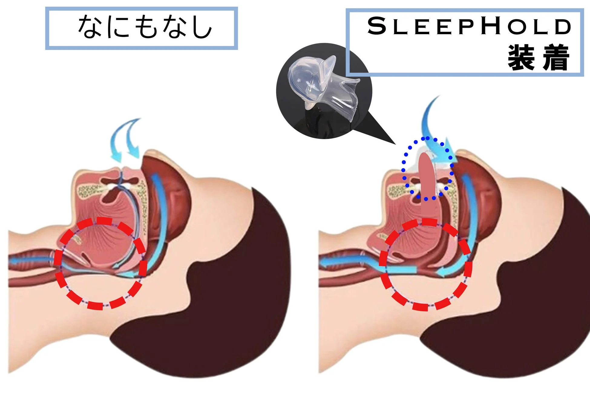 SLEEPHOLD装着時と非装着時の比較
