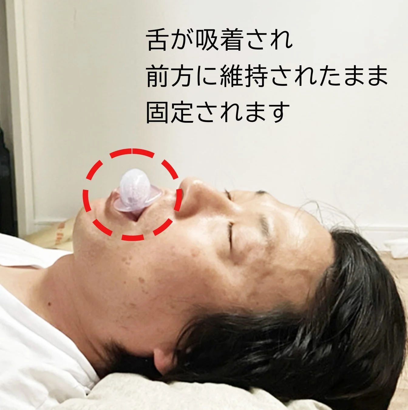 舌が吸着され前方に維持されたまま固定されます