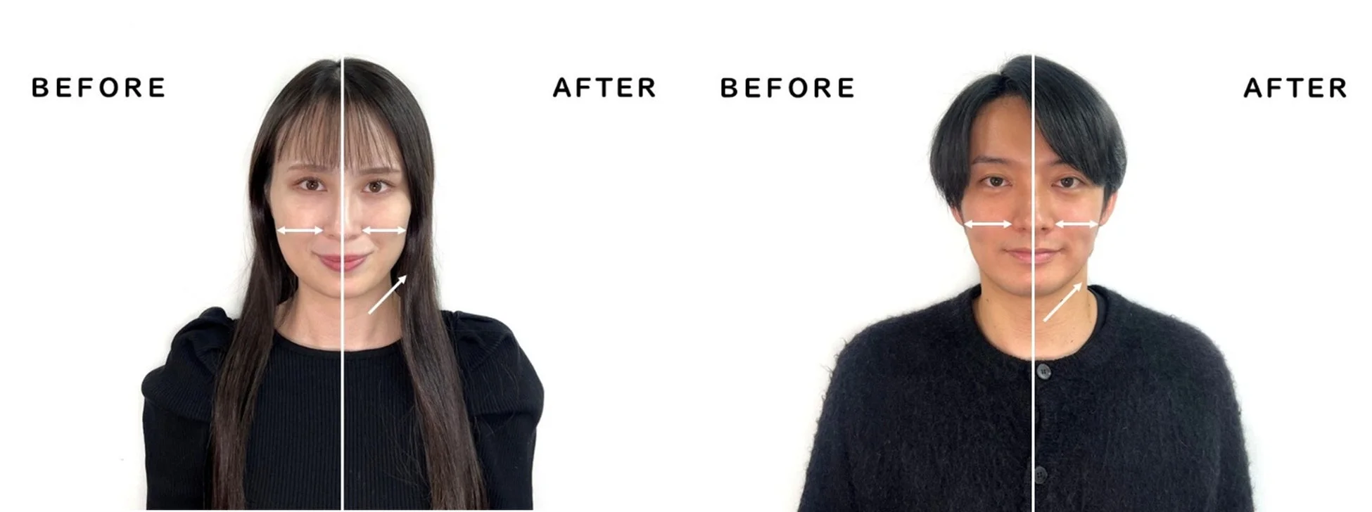 ビフォーアフターで顔の変化を示す画像