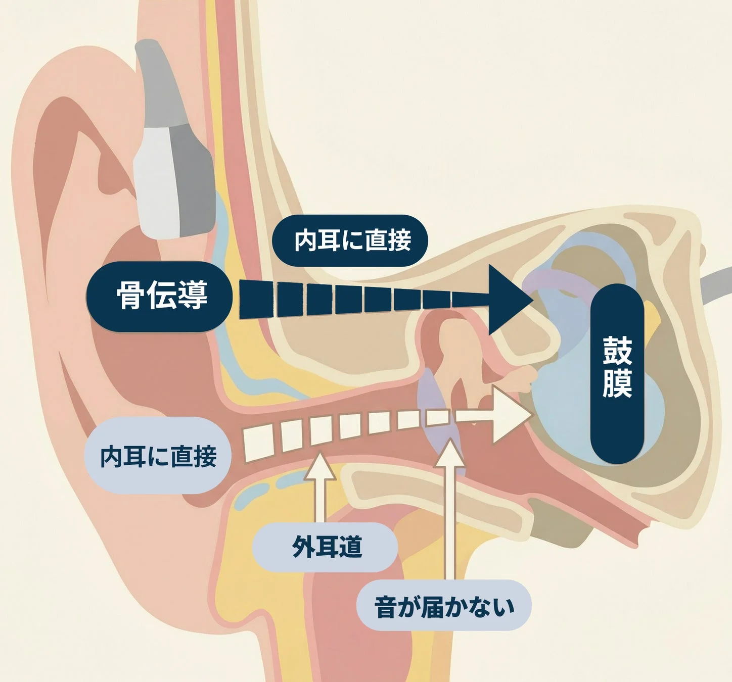 骨伝導 内耳に直接 鼓膜 内耳に直接 外耳道 音が届かない