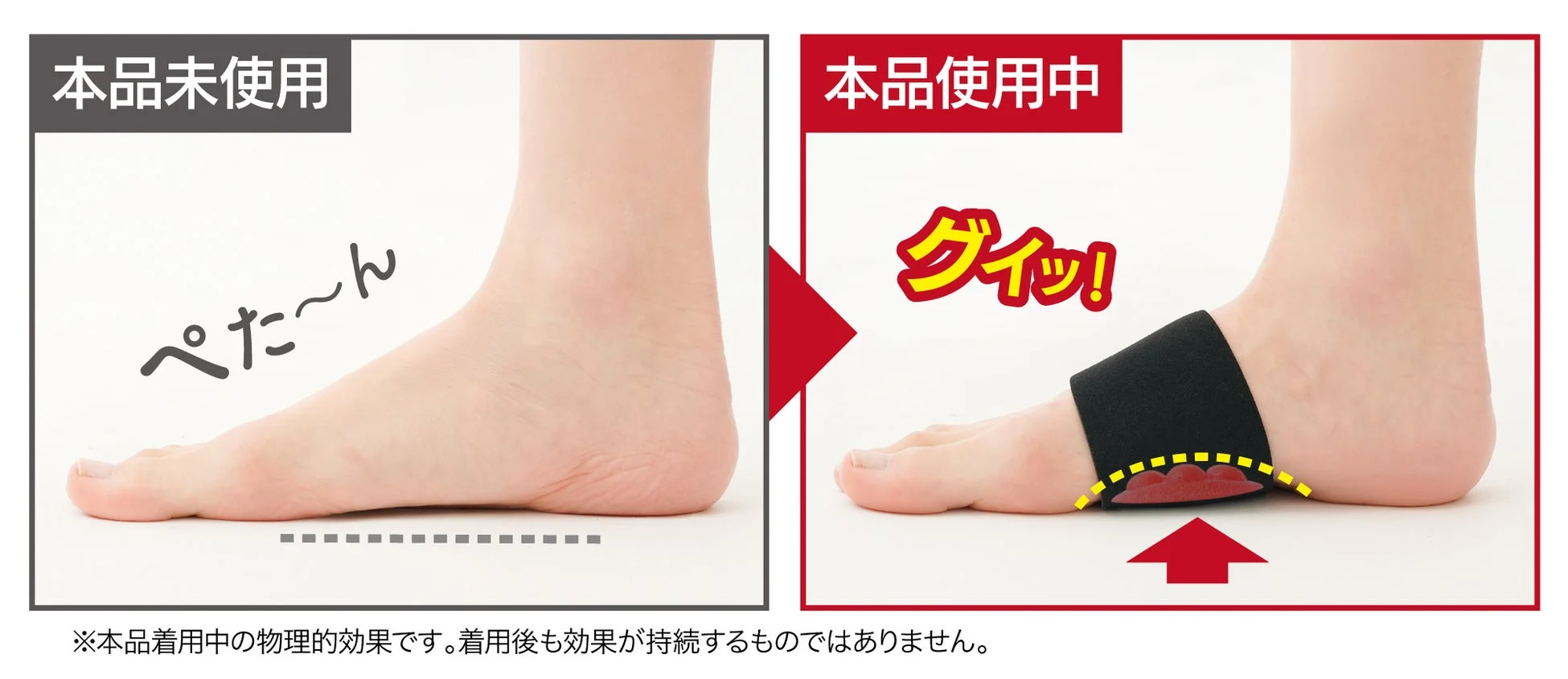 足、扁平足、アーチサポート、フットケア、サポーター、ビフォーアフター、比較、足裏、健康、美容