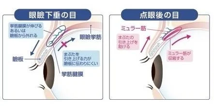 眼瞼下垂のメカニズムと、点眼によってミュラー筋が収縮し、まぶたの引き上げを助ける様子を比較して説明する医療解剖図