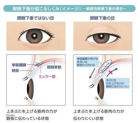 腱膜性眼瞼下垂の仕組みを説明する医療図